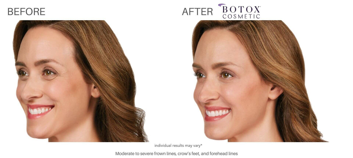 Wrinkle Relaxer | Botox or Dysport — 20 Units or Equivalent