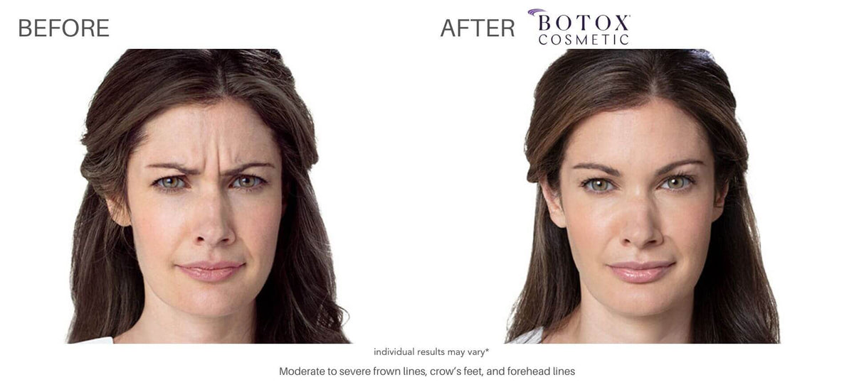 Wrinkle Relaxer | Botox or Dysport — 20 Units or Equivalent