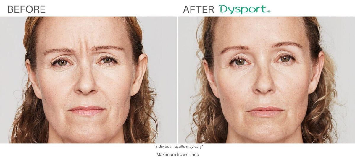 Wrinkle Relaxer | Botox or Dysport — 20 Units or Equivalent