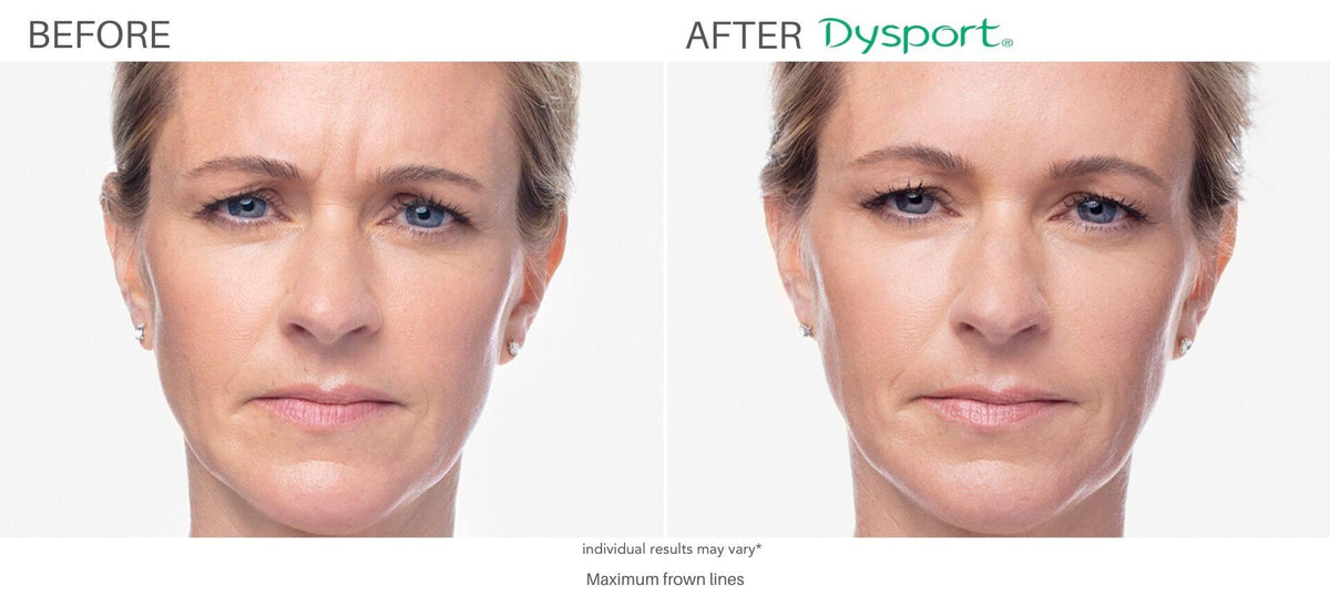 Wrinkle Relaxer | Botox or Dysport — 20 Units or Equivalent