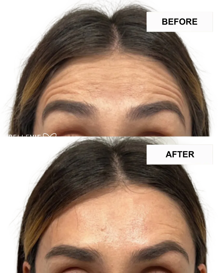 Wrinkle Relaxer | Botox or Dysport — 20 Units or Equivalent