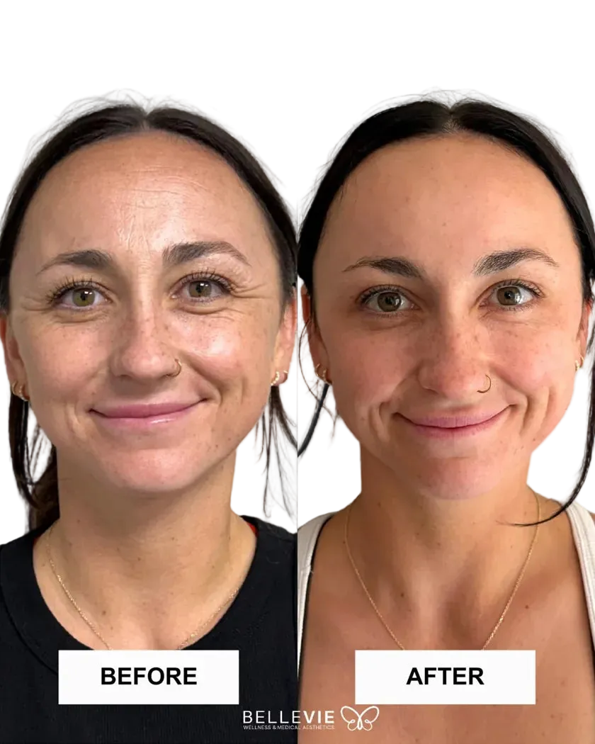 Before-and-after facial photographs from the Belle Vie Botox gallery.