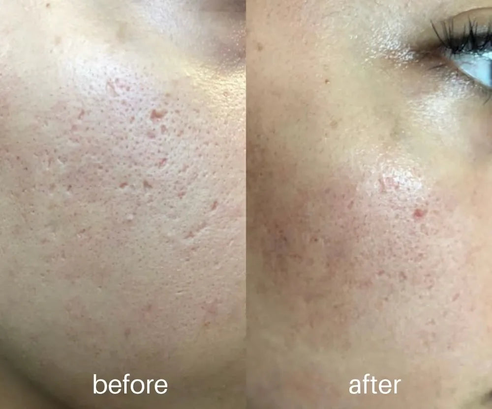 Before-and-after cheek photographs from the Belle Vie microneedling gallery.