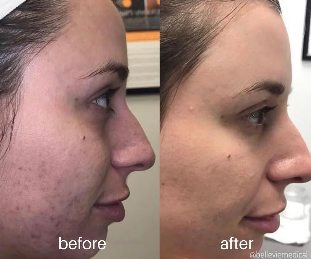 Before-and-after facial photographs from the Belle Vie microneedling gallery.