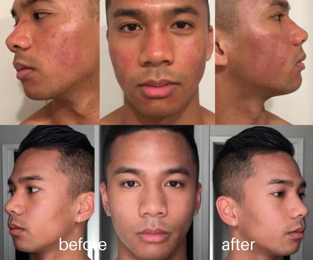 Six-panel facial comparison photographs from the Belle Vie microneedling gallery.